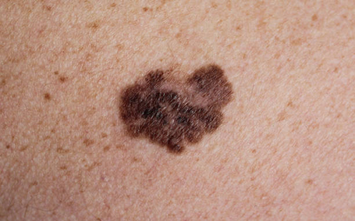 kanker kulit melanoma
